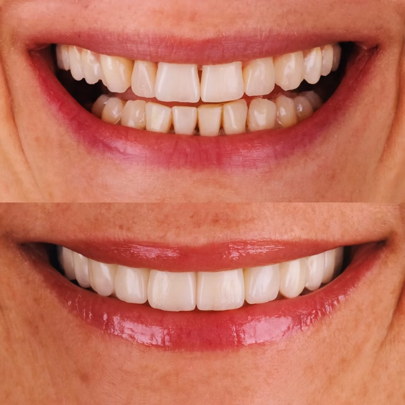 Antes y después de una sonrisa con Carillas Dentales