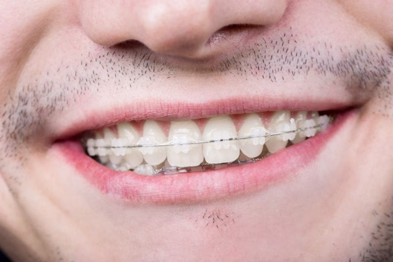 Hombre sonriendo con brackets cerámicos estéticas