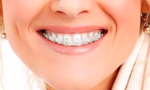 Mujer sonríe mostrando sus brackets de zafiro