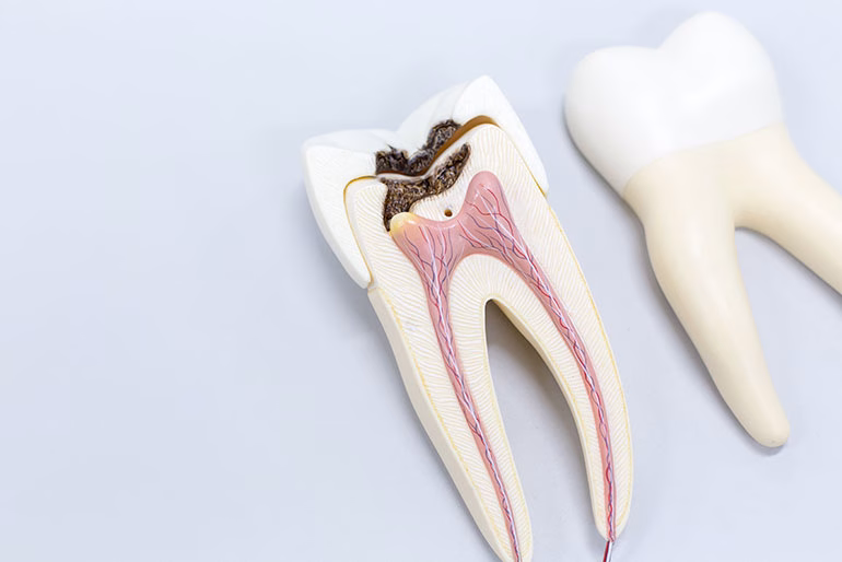 Ejemplo de pieza dental afectada por caries que requiere una endodoncia.