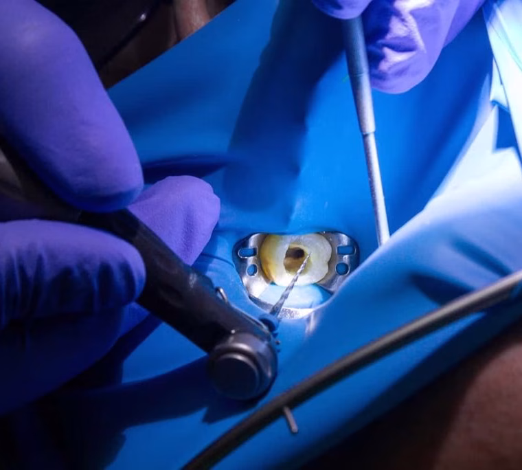 Proceso de tratamiento de endodoncia.