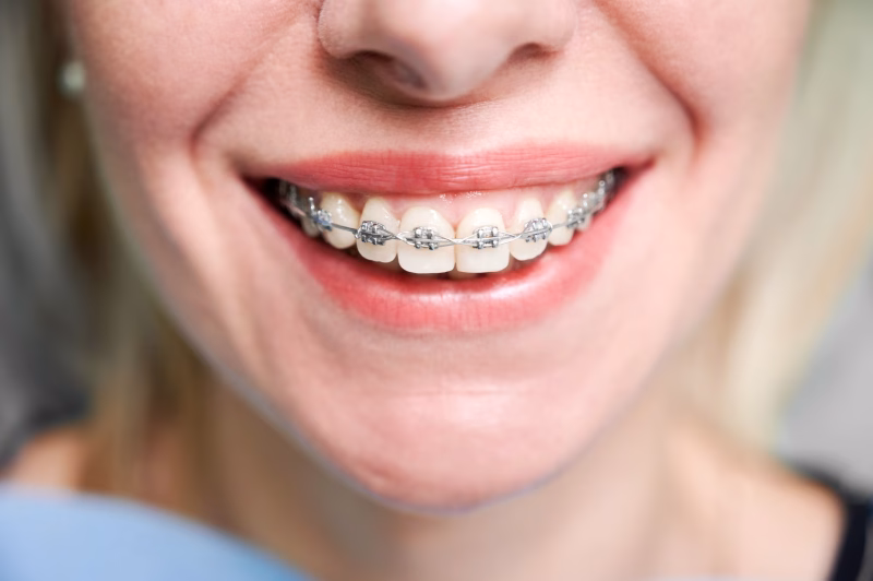 Mujer sonriendo con brackets metálicos tradicionales